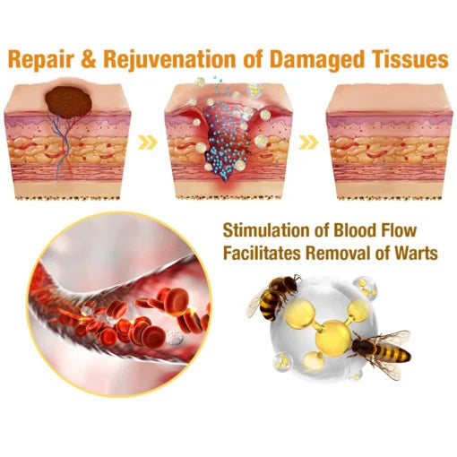 Honey Nevus Removal